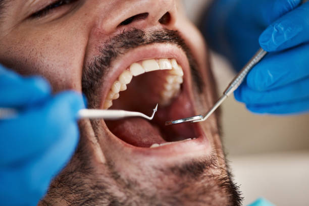 Best Emergency Dental Care for Broken or Chipped Teeth in Frisco, TX